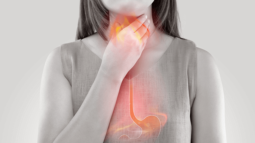 Gyomor- es torokszorito betegseg a reflux 16 9